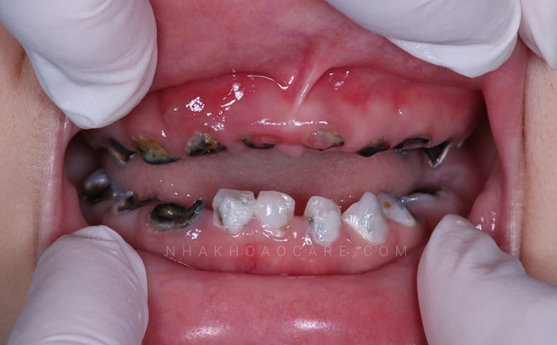 Why Do Cavities Happen?